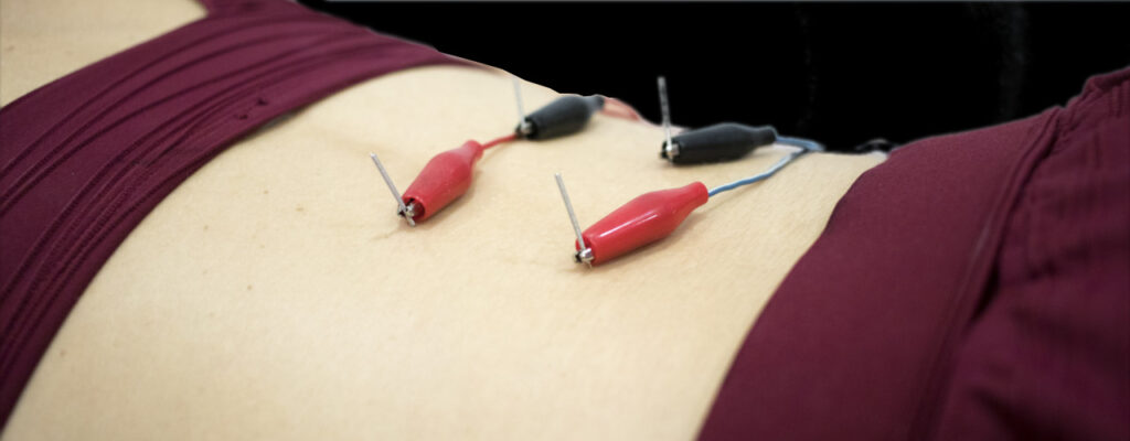 Why Does Adding Electricity to Dry Needling Make It More Effective?