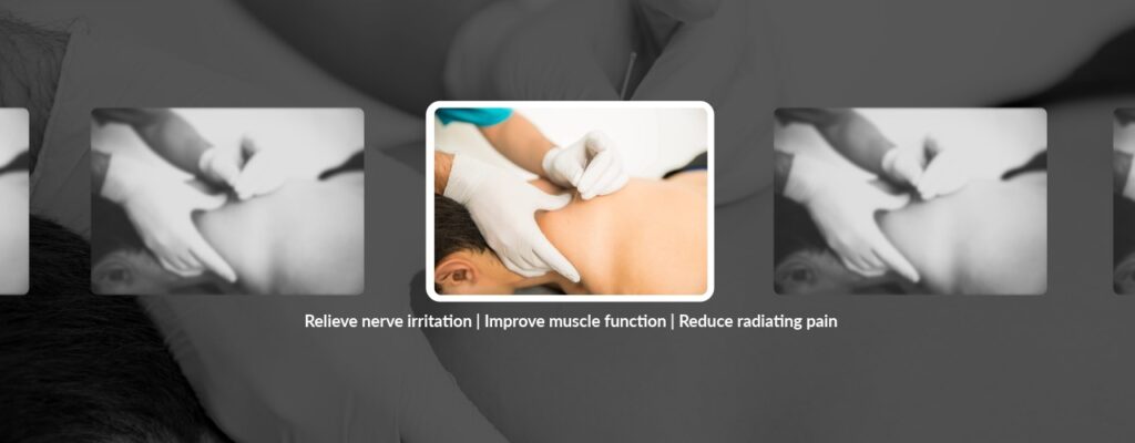 How Dry Needling Helps When Nerve Pain Won’t Let Up